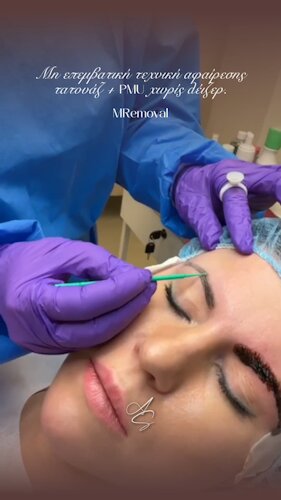 Tattoo Removal<br>MRemoval